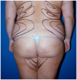 Lipoescultura