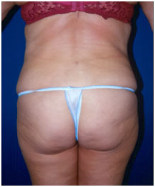 Lipoescultura