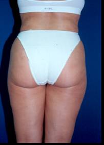 Lipoescultura