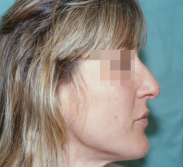 rinoplastia