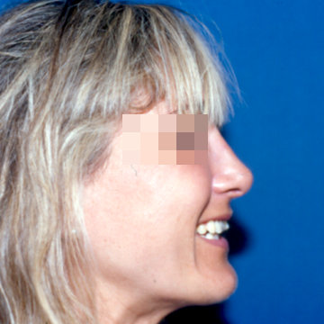 rinoplastia