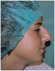 rinoplastia