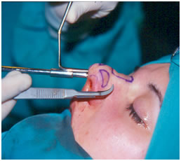 rinoplastia
