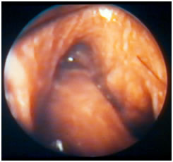 rinoplastia